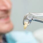 How Expert Dentists Perform Tooth Extraction for Patients in Selkirk