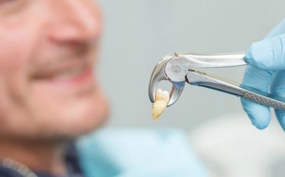 How Expert Dentists Perform Tooth Extraction for Patients in Selkirk