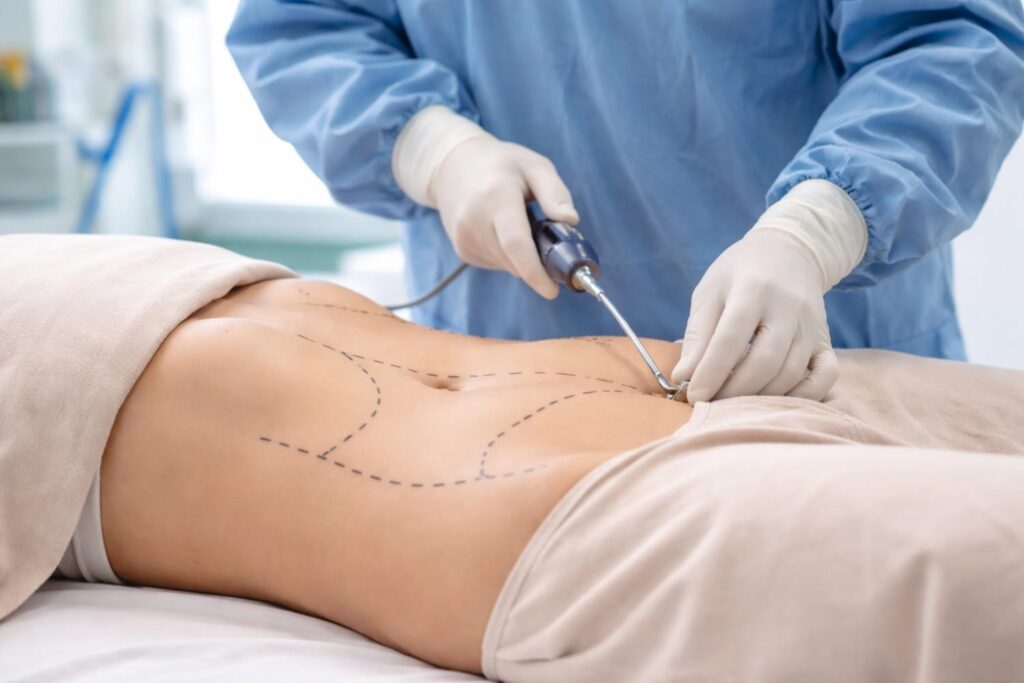 What Is Liposuction?