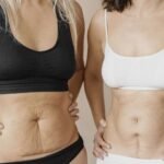 Liposuction vs. Tummy Tuck