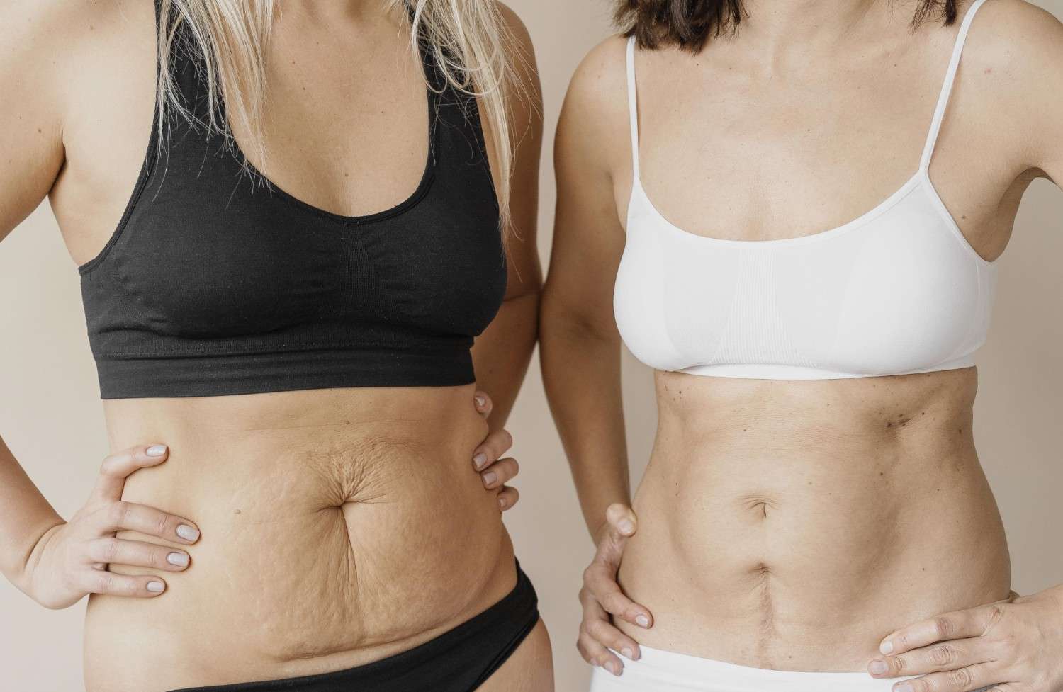 Liposuction vs. Tummy Tuck